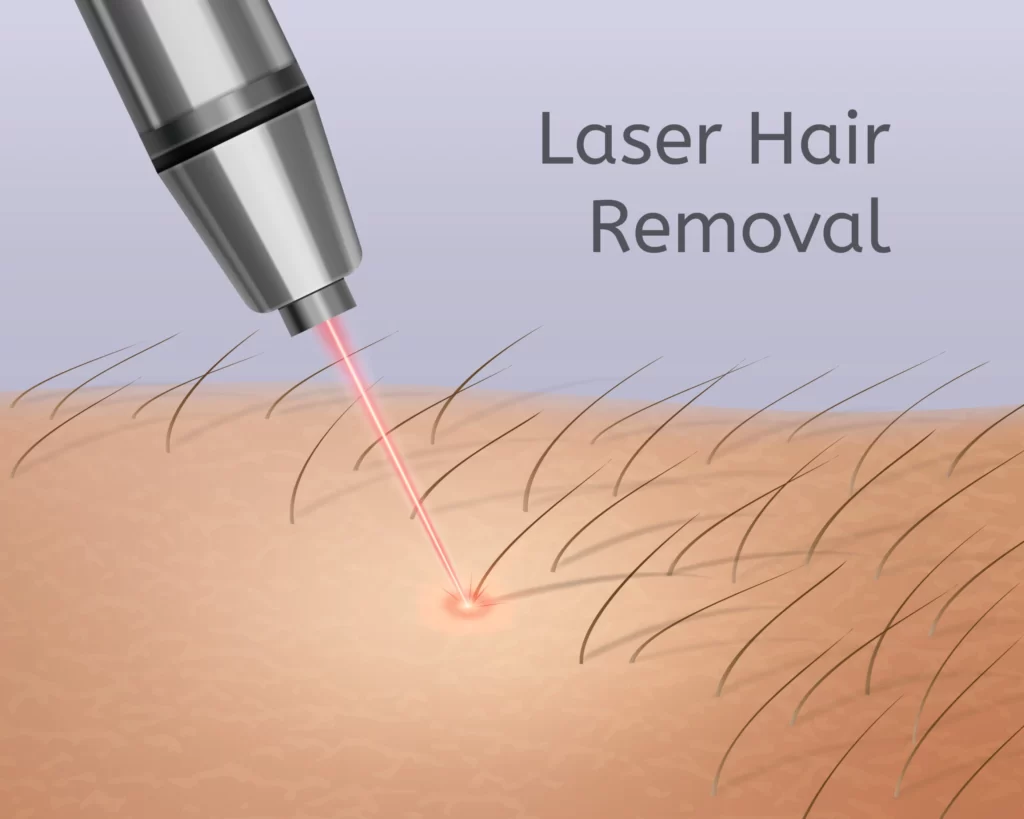 Laser Hair Removal